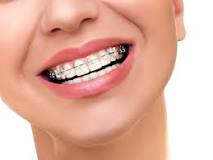 What is the shortest time period for braces?